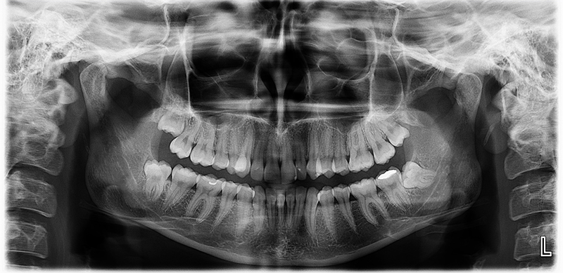 Pantomogram